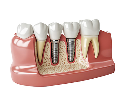 An illustration of a human tooth with a visible root canal procedure, showing the hole where a screw is inserted and the surrounding dental structure.