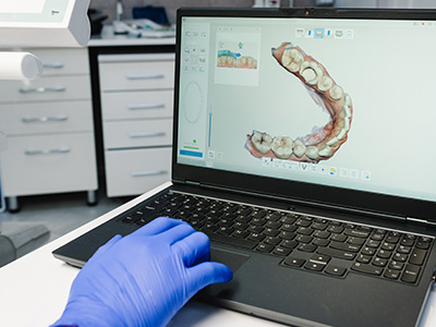 The image shows a laptop screen displaying a 3D rendering of a human tooth with a dental implant, and there is a person s hand wearing gloves interacting with the laptop.