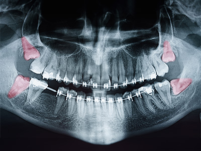 An X-ray image of a human skull with red markers highlighting certain areas, showcasing dental implants and orthodontic devices.