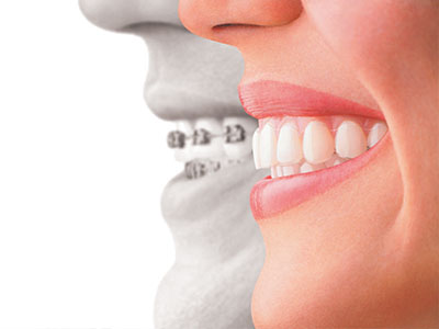 The image is a split-screen photograph showing a person on the left with a smiling expression and a mouthful of teeth, while on the right, there s an overlay of a smiling mouth with straight white teeth.