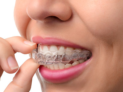 A person with a clear aligner, brushing their teeth.