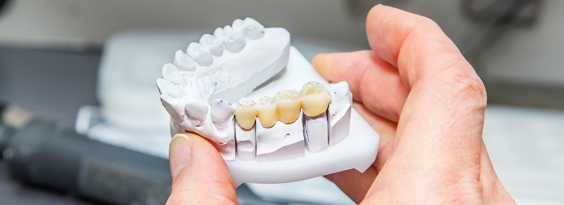 The image shows a person holding a dental implant with multiple teeth-like structures, possibly for demonstration or educational purposes.