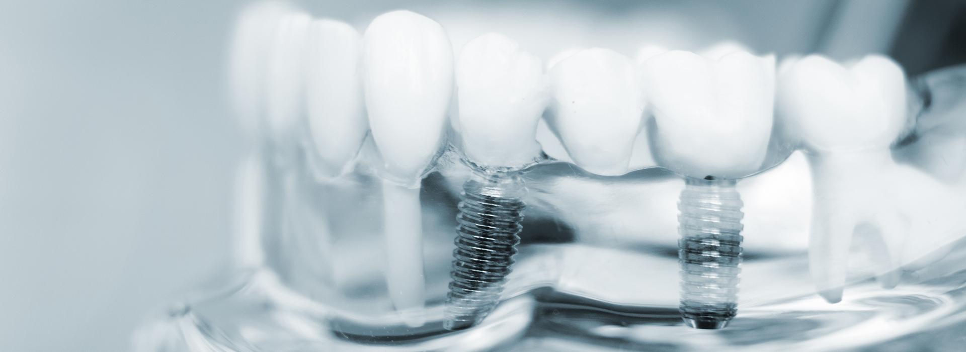 The image shows a close-up of a dental implant with a screw and an abutment, placed against a blurred background.