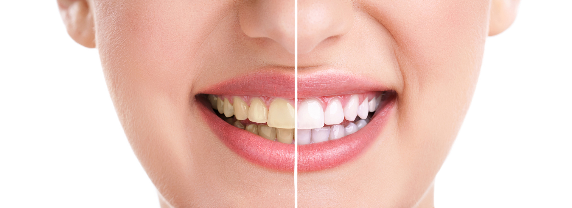 The image shows a close-up of a person s face with a focus on teeth whitening, featuring before and after effects.