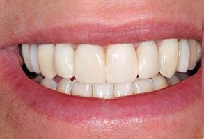 The image shows a close-up of a person s mouth with a bright, white smile, displaying straight, well-maintained teeth and gums.