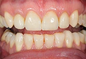 The image shows a close-up of a person s teeth with yellowing, indicating the need for dental care.