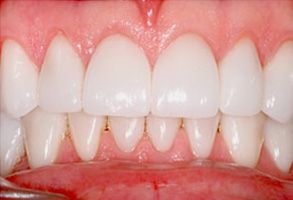 An image of a person s teeth with a focus on the front, showcasing a bright smile and dental implants.