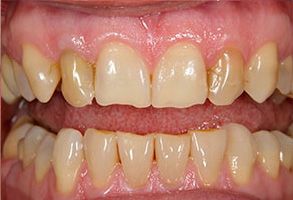 The image shows a close-up of a person s teeth, which appear to be a before and after comparison of dental work with a focus on the upper front teeth.