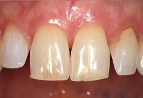 Dental implant with a porcelain crown on the upper front tooth.